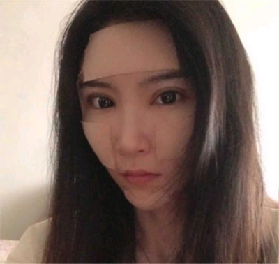 南昌永康王忠干自体脂肪全脸填充怎么样?案例分享