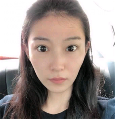 南昌永康王忠干自体脂肪全脸填充怎么样?案例分享
