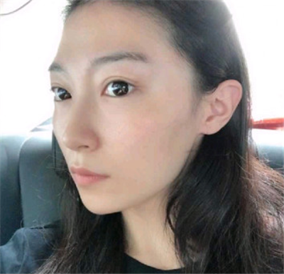 南昌永康王忠干自体脂肪全脸填充怎么样?案例分享