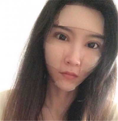 南昌永康王忠干自体脂肪全脸填充怎么样?案例分享