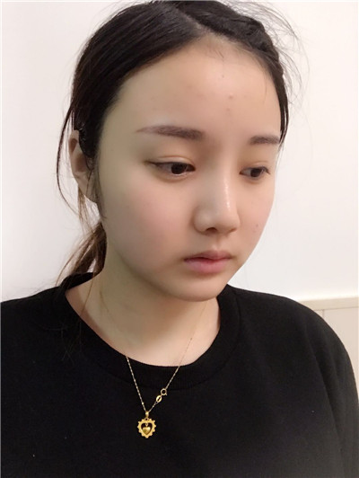 南京柠檬郑翔宇面部吸脂怎么样?案例分享