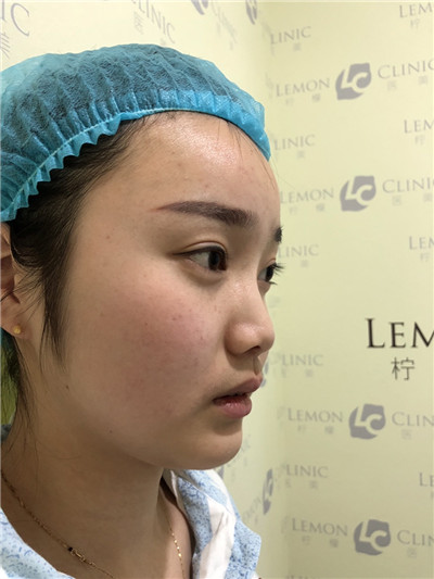 南京柠檬郑翔宇面部吸脂怎么样?案例分享