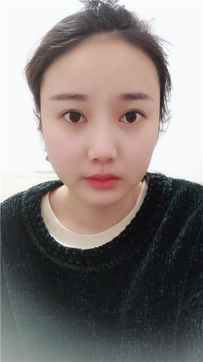 南京柠檬郑翔宇面部吸脂怎么样?案例分享