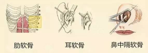 自体软骨隆鼻怎么样?