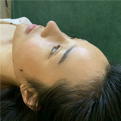 天津菲丝澜党涛肋软骨隆鼻怎么样?案例分享