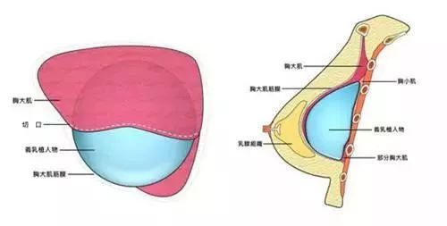 隆胸和真胸,你能区分出来?
